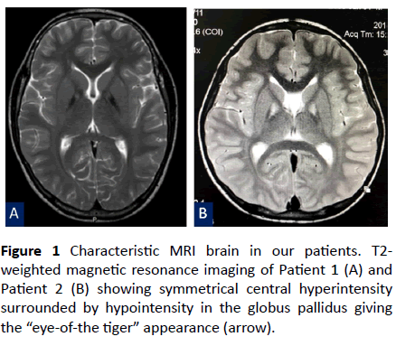 Molecular Analysis Of Pank2 Gene In Two Thai Classic Pantothenate Kinase Associated Neurodegeneration Pkan Patients Insight Medical Publishing